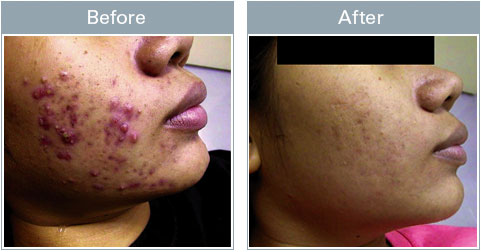 Retin A Before After Acne | www.pixshark.com - Images Retin A Before After Acne | www.pixshark.com - Images