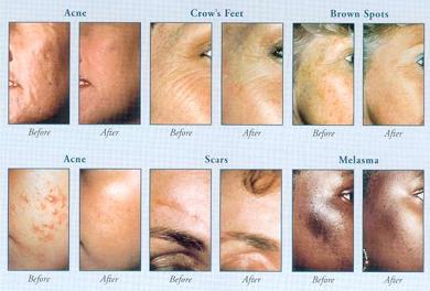 photo: Dermabrasion Treatment performed by Dr. Donald R. Revis Jr., MD 