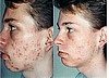 Grade IV Cystic Acne