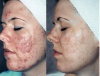 Grade IV Cystic Acne, Scarring, Hyperpigmentation