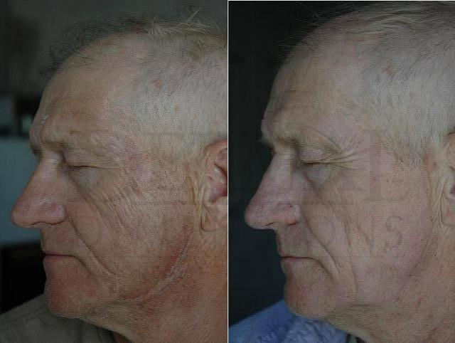 Photo Aging - Hyperpigmentation - Lines