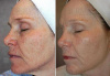 Photo Aging/Hyperpigmentation