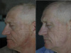 Photo Aging - Hyperpigmentation - Lines